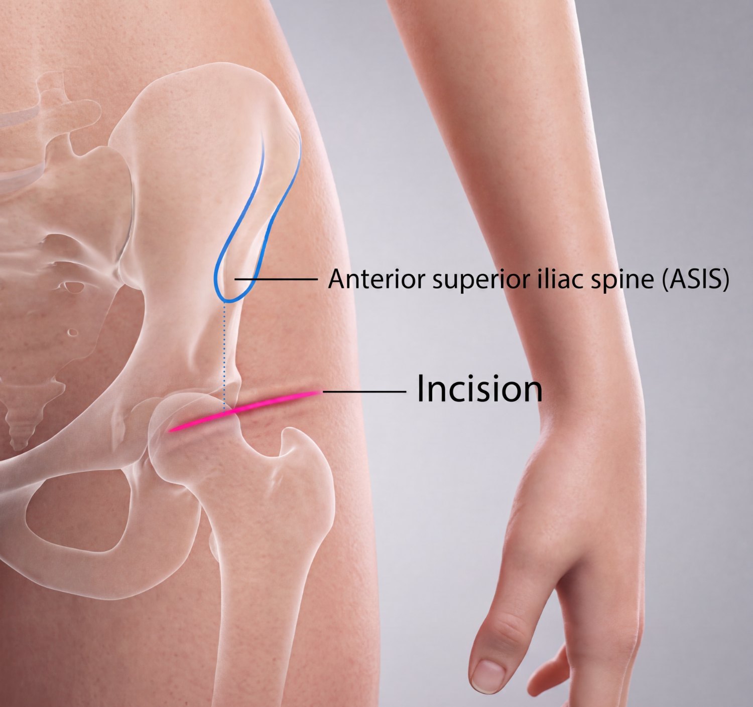 Illustration of the hip showing the anterior superior iliac spine and the oblique bikini incision placed low in the groin crease